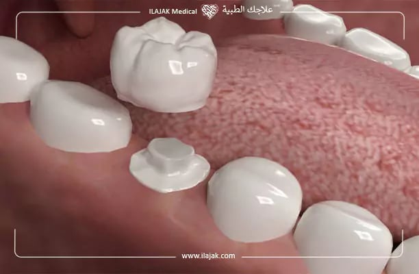 افضل انواع تيجان الاسنان في تركيا