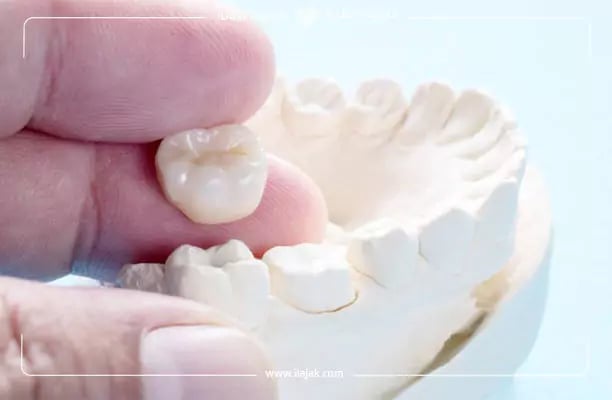 أسعار تيجان الاسنان في تركيا