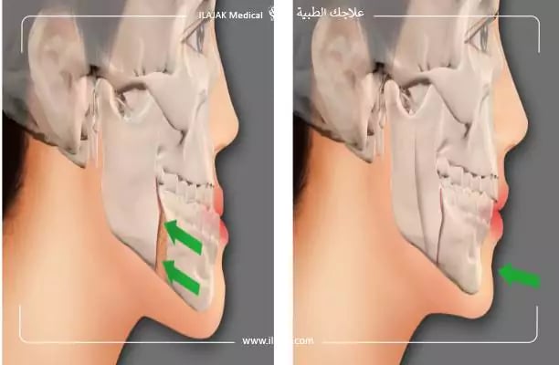 عملية الفك قبل وبعد
