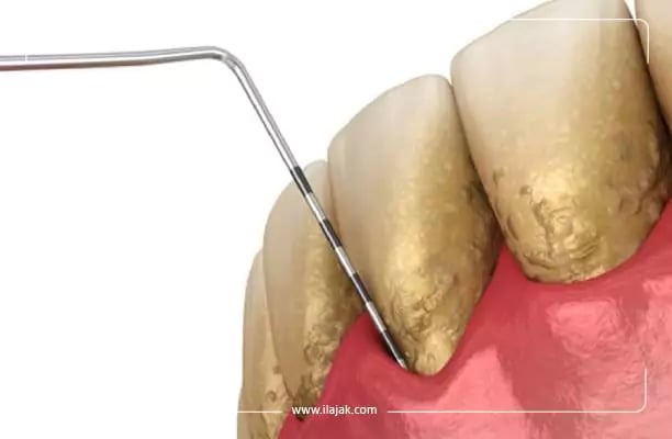 تنظيف الأسنان بانتظام كأحد طرق حماية اللثة وتقويتها