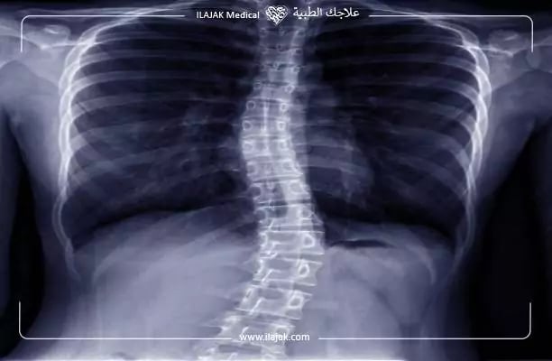 جراحة العمود الفقري في تركيا