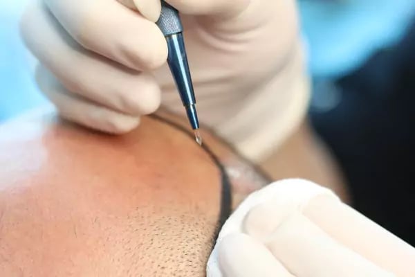 زراعة الشعر