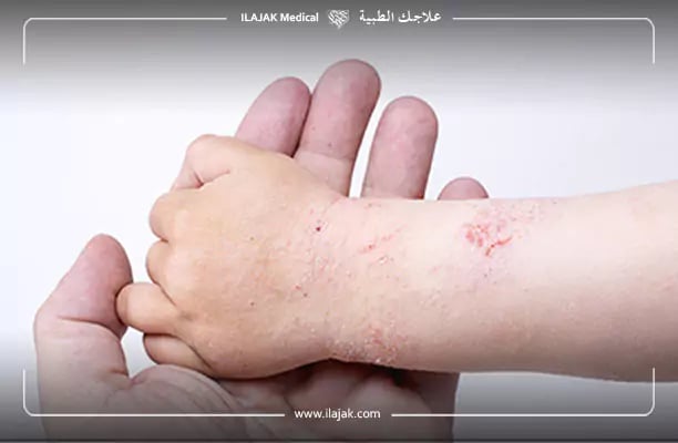أنواع الأكزيما وصورها - التهاب الجلد التأتبي