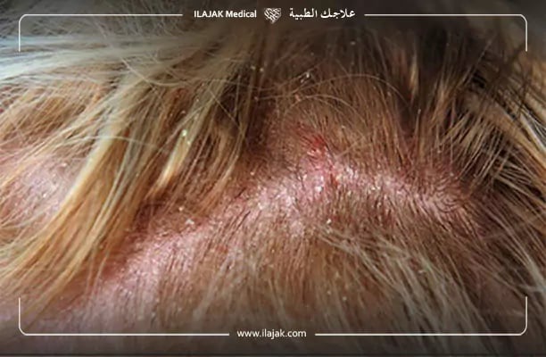 التهاب الجلد المثي او اكزيما الشعر