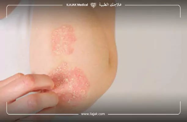علاج الأكزيما نهائيا