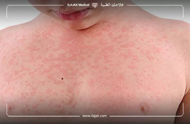 أعراض الاكزيما للاطفال