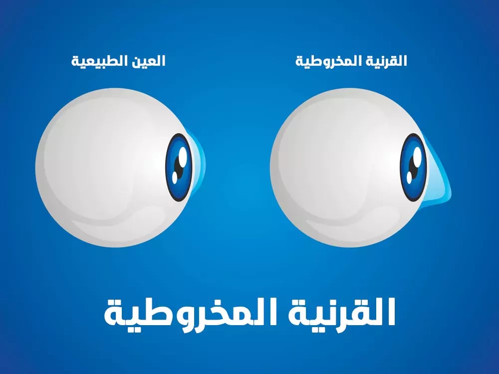 الفرق بين القرنية المخروطية والطبيعية 
