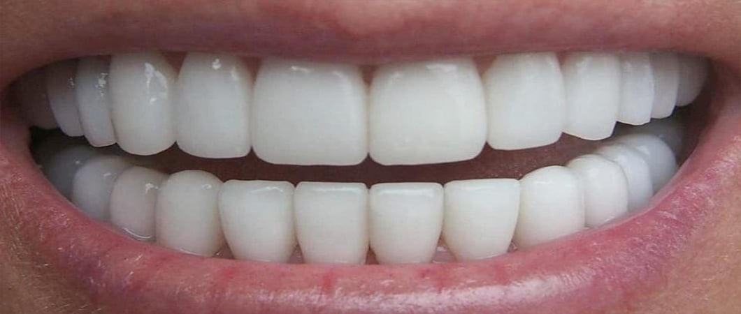 Teeth Crowding