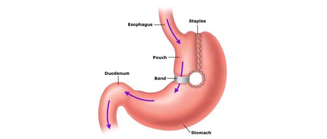 Obesity treatment in Turkey