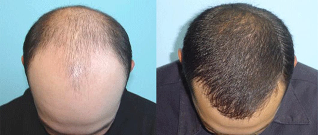 زراعة الشعر في تركيا