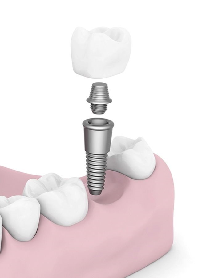 Zirconia Dental implant