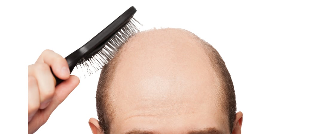 treatment of male baldness