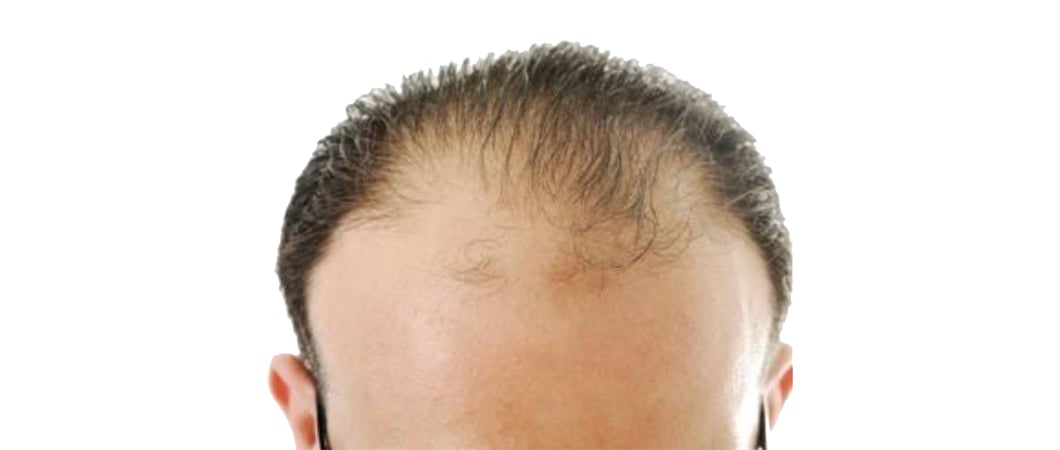Hereditary-pattern baldness