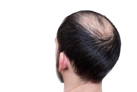 treatment of hereditary-pattern baldness