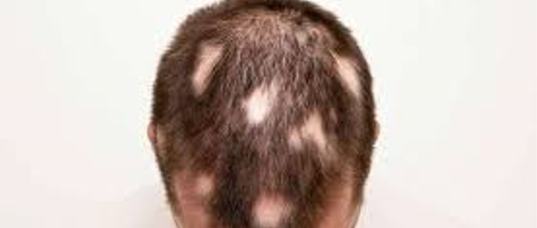causes of baldness in men