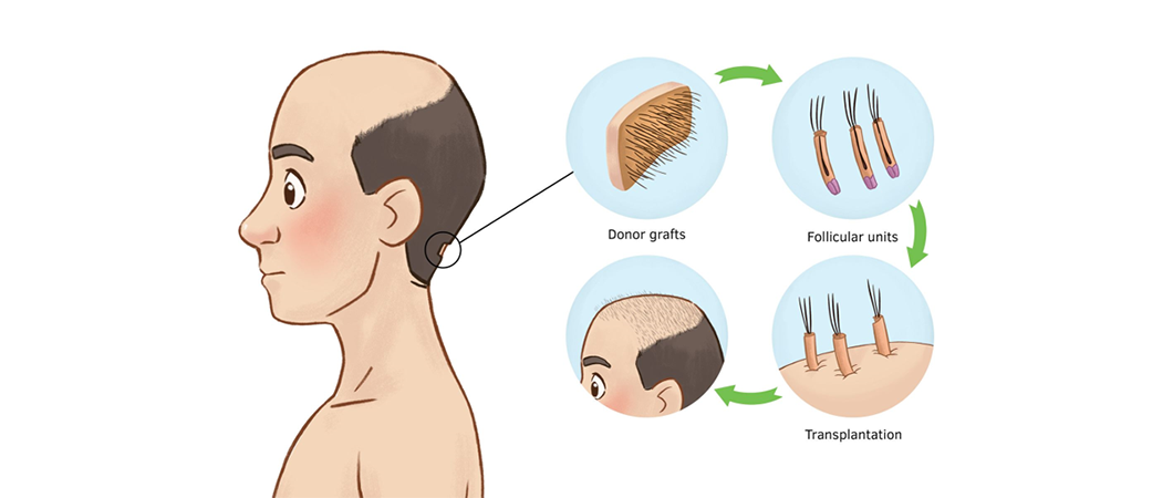 Men baldness