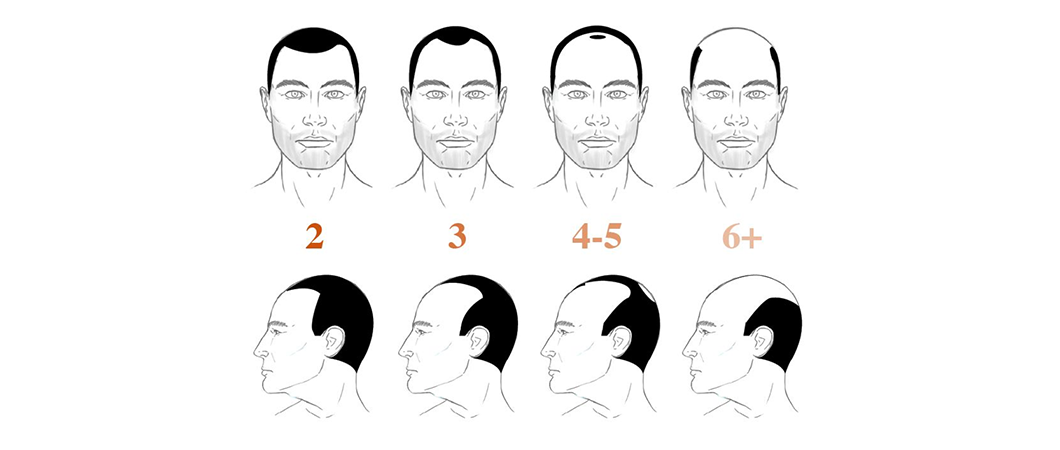 causes of early baldness in youth