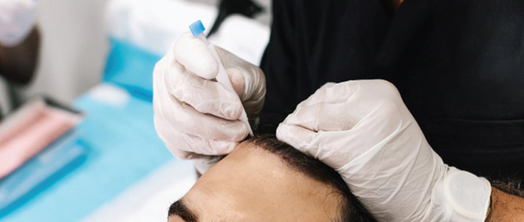 Hair transplant without shaving technique