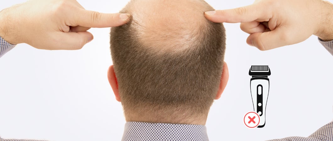 hair transplant without shaving