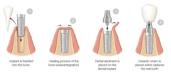 dental implant 