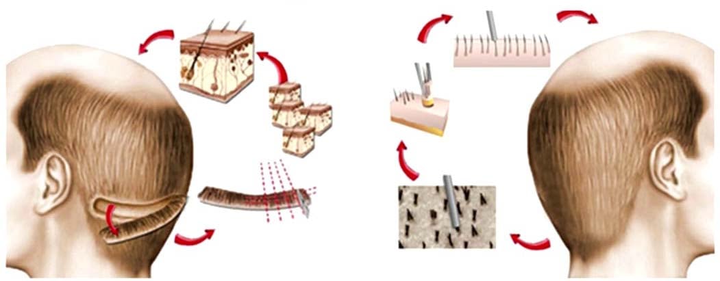 زراعة الشعر في تركيا