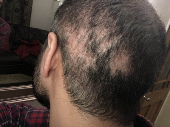 تضرر المنطقة المانحة - فراغات بعد زراعة الشعر