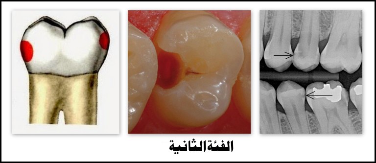 تسوس الأسنان : أسباب تسوس الأسنان وكيفية علاجه | علاجك الطبية