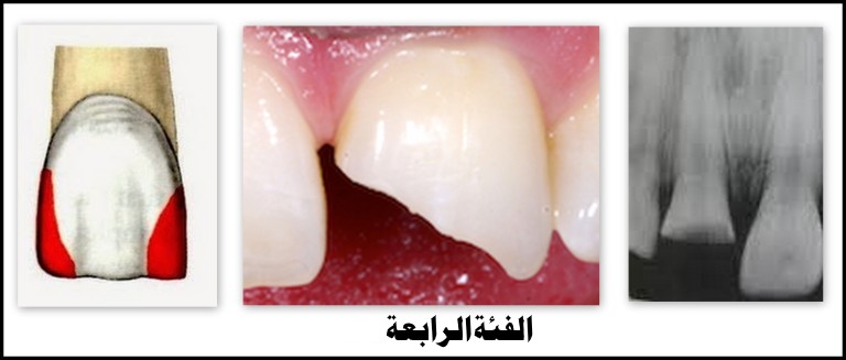 صيب التسوس الزوايا القاطعة للأسنان الأمامية.