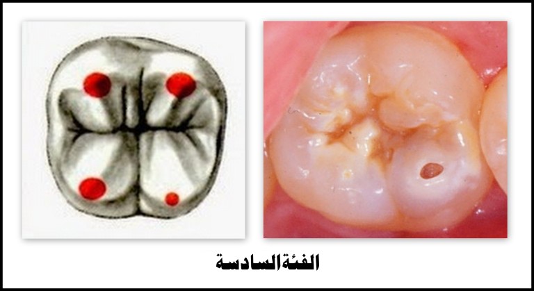 تسوس الأسنان : أسباب تسوس الأسنان وكيفية علاجه | علاجك الطبية