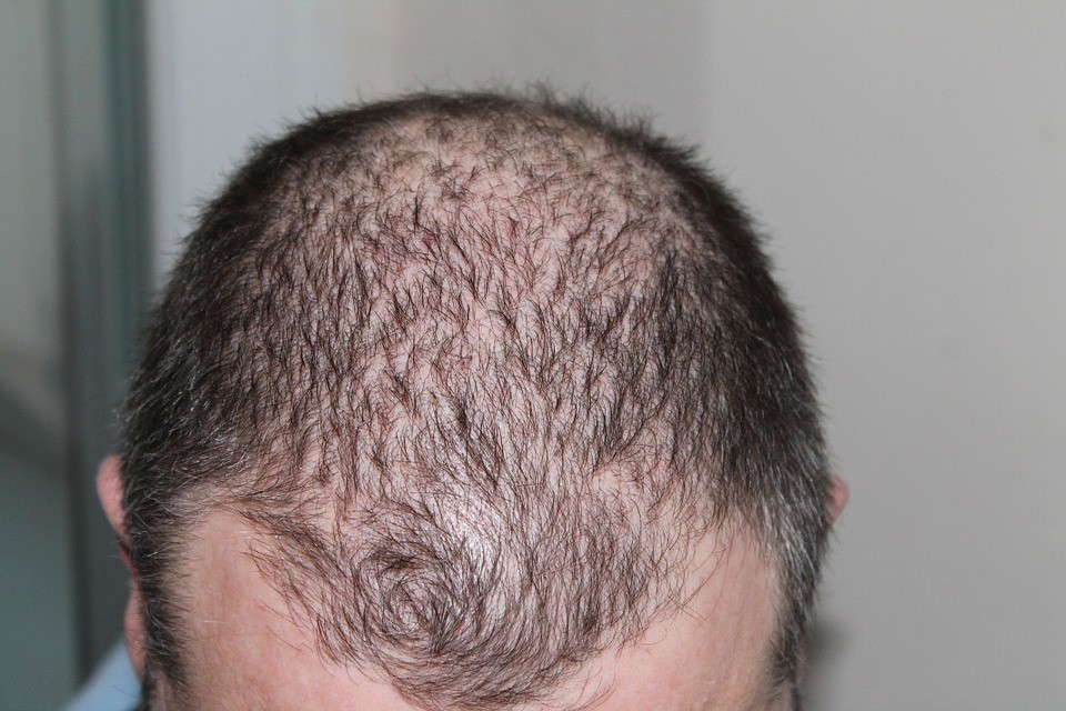 Shock hair loss after hair transplant