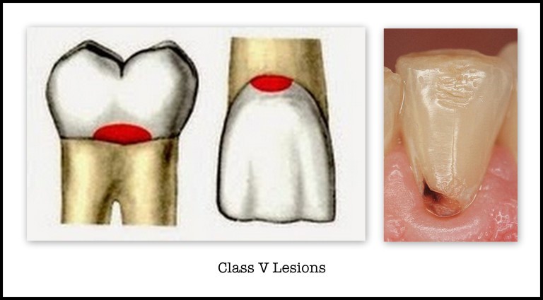 Cavities located in the gingival third