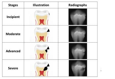 tooth decay can be divided into several categories