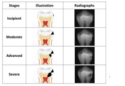 tooth decay can be divided into several categories