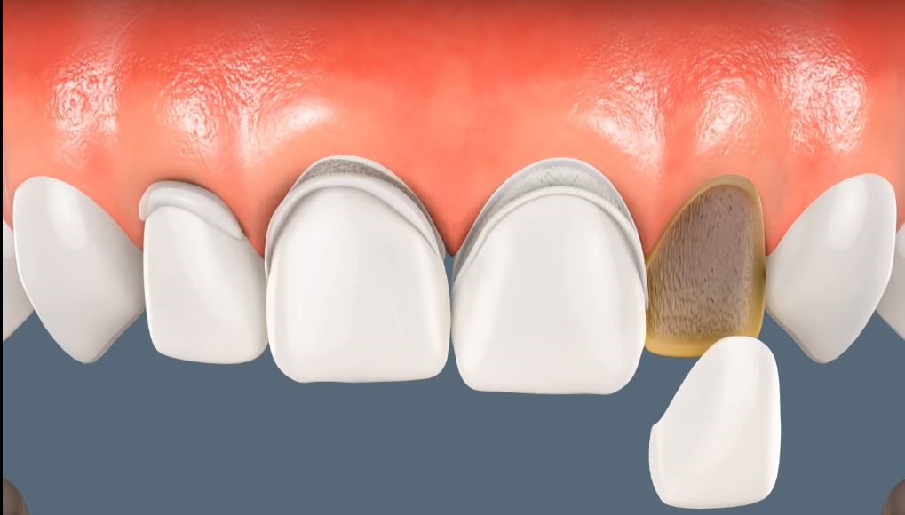 removable veneers