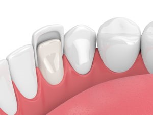 Veneers or Crowns