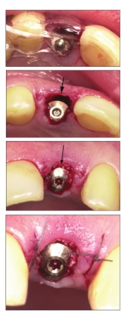 مراحل زراعة الاسنان الفورية