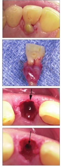 implant dentaire immédiat