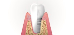 traditional implants