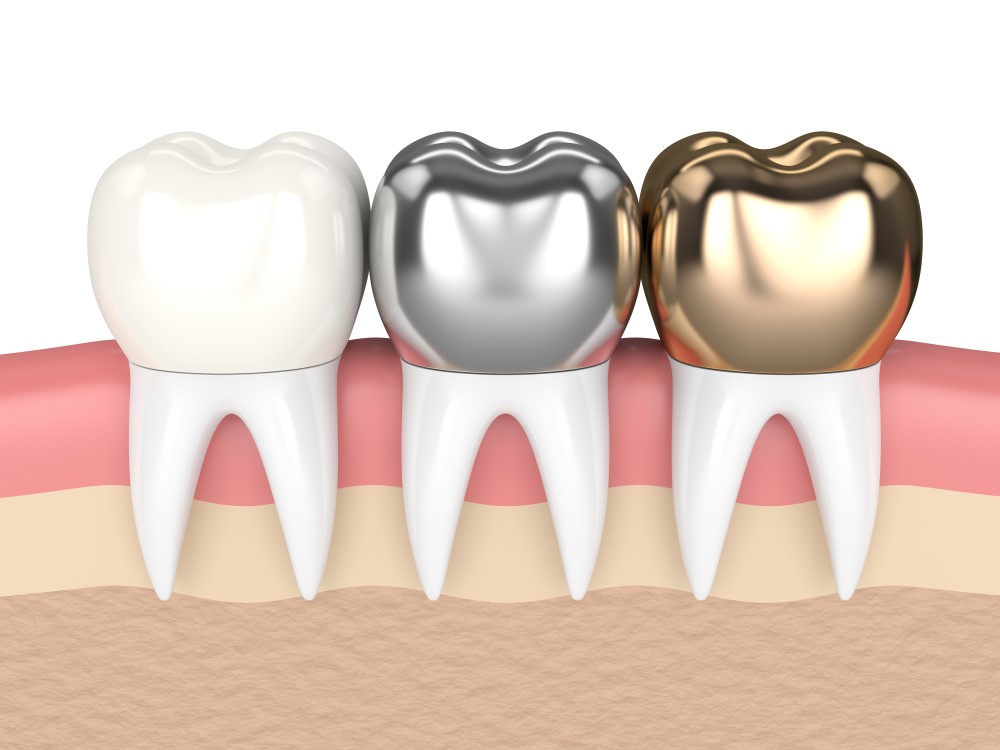 Different types of dental crowns