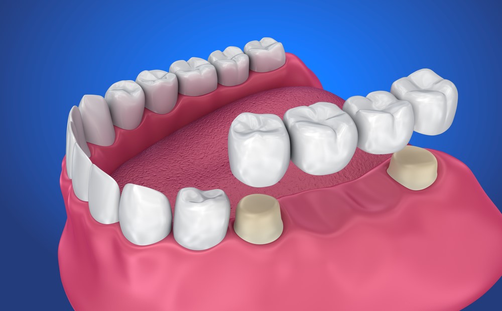Temporary crown dental