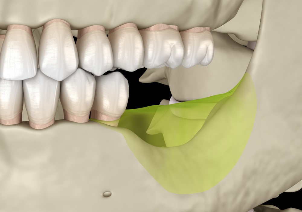 Jaw atrophy