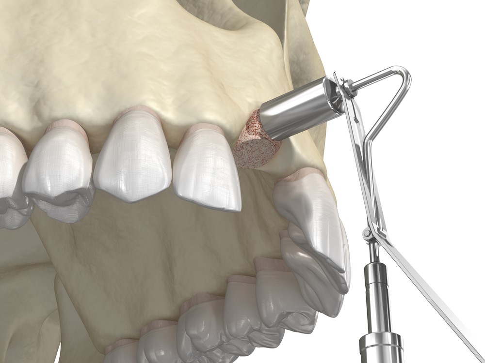 Bone graft procedure