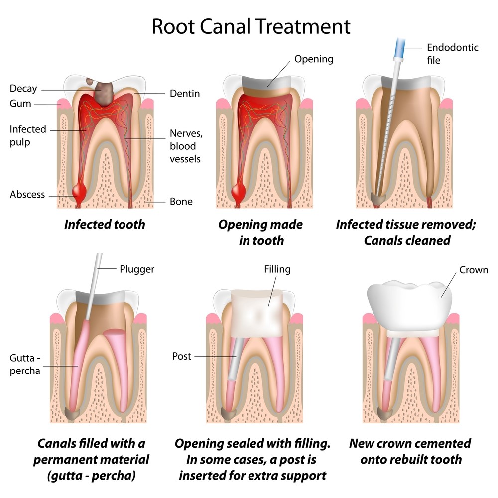Root canal treatment steps 