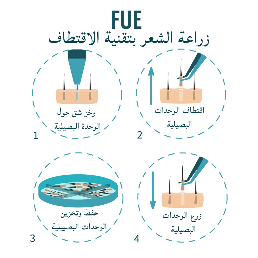 مراحل زراعة الشعر بتقنية FUE