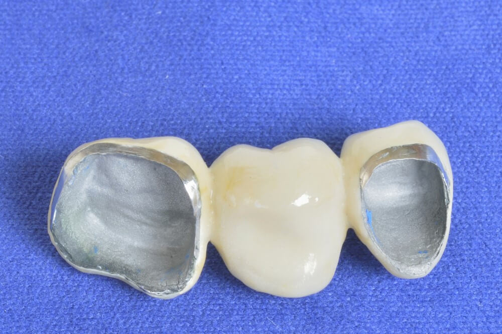 Porcelain dental bridge tooth