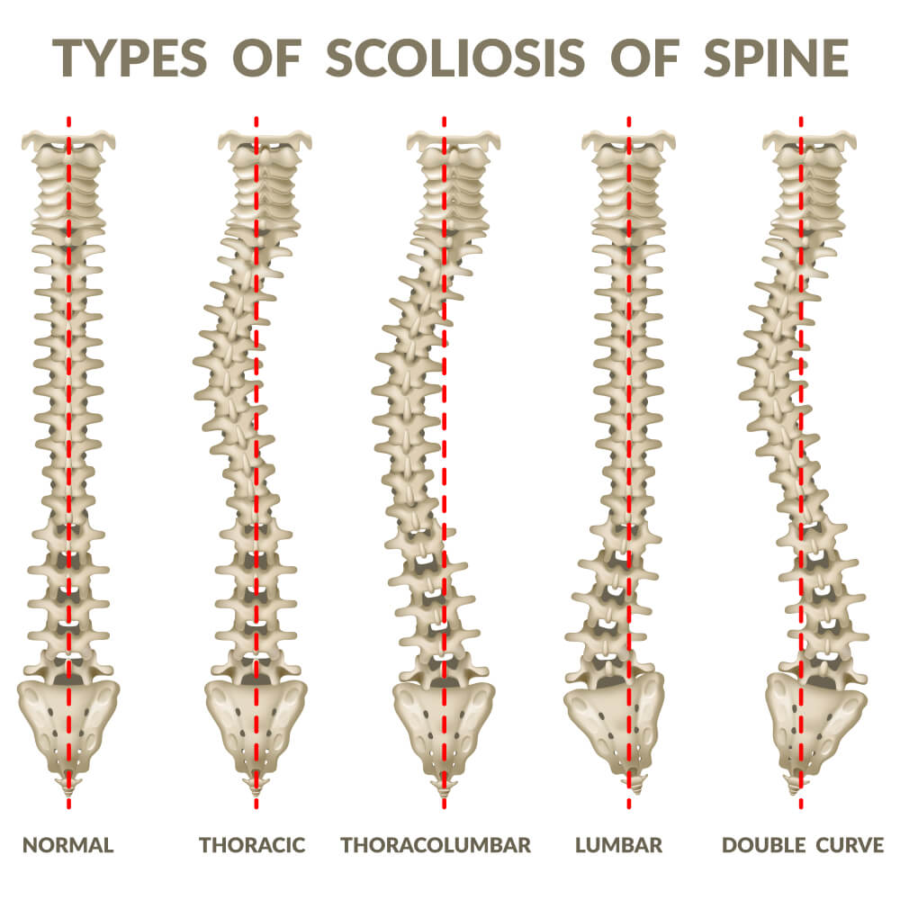 types of scoliosis pain