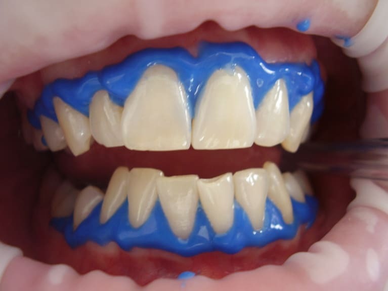 مراحل تبيض الأسنان بالليزر