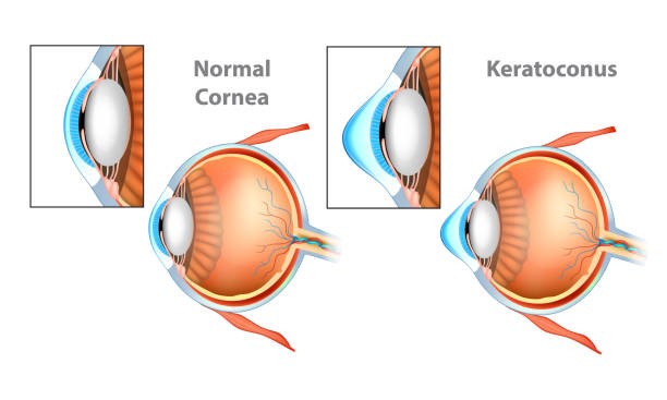 Kératocône en image