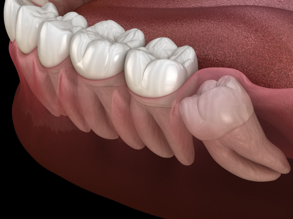 ضرس العقل المدفون جزئيًا