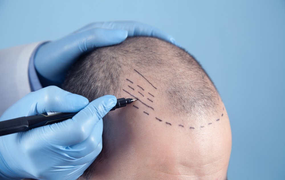 ما هي مراحل زراعة الشعر قبل وبعد؟